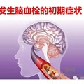 腦血栓前兆，當天6個暗號，為家人，看一眼！