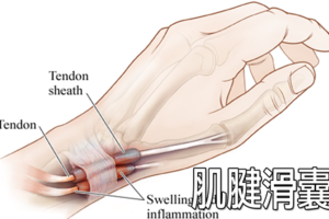 「媽媽手」發作時不但手指無力，肌腱受損更是後患無窮，「5個動作」自救肌腱不求人。
