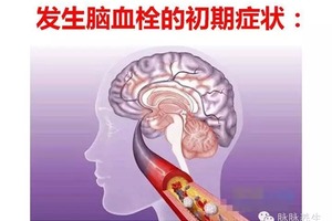 腦血栓前兆，當天6個暗號，為家人，看一眼！