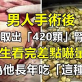 男人手術後從體內取出「420顆」腎結石...醫生看完差點嚇暈！只因為他長年吃「這種東西」。