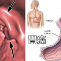 腹脹、噁心非小事！「四種症狀」恐是「胃癌」早期警訊，破壞「胃黏膜」的元兇竟是它！