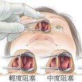 以前都不知道…原來鼻塞可以這麼簡單解決！痛苦的日子終於要結束了，學起來就可以暢快呼吸！