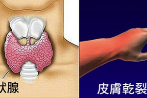 「甲」的！如廁、皮膚「七問題」自我診斷，「甲狀腺功能」低下、正常、亢進一目了然！