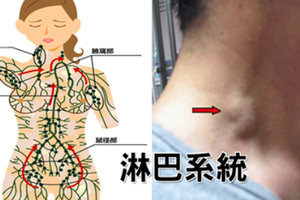  「肥胖」、「癌細胞」的幕後黑手是「淋巴堵塞」！5招「淋巴暢通法」排毒消腫「免花錢」