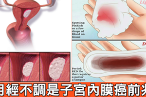 「月經不順」非小事！「六大症狀」恐是子宮內膜癌變前兆，這種出血狀況最危險