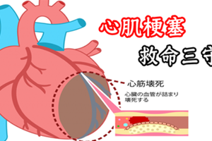 「心肌梗塞」不可亂吃藥！「五種症狀」、「救命三守則」五大高危險群自救必當心！