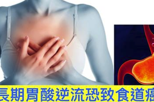 胃灼熱、胃酸逆流久治不癒？早上一杯咖啡害的！五大錯誤飲食、生活習慣，害你胃酸翻騰，長期恐致「食道癌」