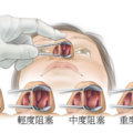 以前都不知道，原來鼻塞可以這麼簡單解決！這幾招學起來就可以暢快呼吸...