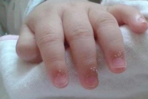 寶寶手指長這種「肉刺」，當媽的就可要多留個心眼兒！