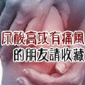 《尿酸高或有痛風史的朋友請收藏》 