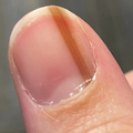 25歲女指甲出現「褐色直線」以為是痣　10年後才知是罹癌