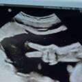 奇蹟瞬間！媽媽照超音波「寶寶肚中比YA」　爸爸傻了：當時突然就有2隻手指頭伸出來