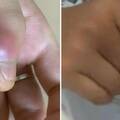 13歲弟愛咬指甲「食指突紅腫化膿」　醫看X光片驚：再晚就要截肢