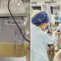 40歲男酒後急送加護　「血抽出來變牛奶色」醫嘆：重症了