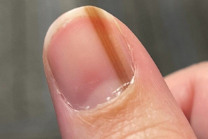 25歲女指甲出現「褐色直線」以為是痣　10年後才知是罹癌