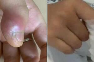 13歲弟愛咬指甲「食指突紅腫化膿」　醫看X光片驚：再晚就要截肢