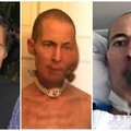 38歲帥熟男「左臉被巨大腫瘤吃掉」還越長越大！4年後醫生出手相救「康復模樣惹哭全球」！