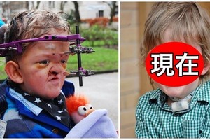 「畸形臉小男孩」被鄰居媽媽狠罵「不要出來嚇人！」50次重建手術後「新造型惹哭所有人」！