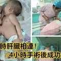 男嬰出生時肝臟相連！4小時手術後成功分離！