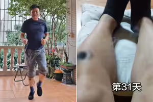 男子自學艾灸　33天後「雙腿驚現黑洞」仍不停