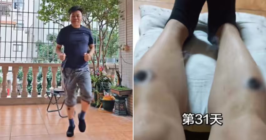 男子自學艾灸　33天後「雙腿驚現黑洞」仍不停
