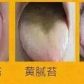 濕氣重造成體內毒素瘀積，3個穴位巧妙除濕，排凈體內10年濕毒！