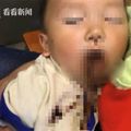 筷子插進嘴巴＋眼眶…1歲半童滿臉鮮血　媽：嚇到腿軟