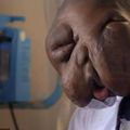 16歲少年罹罕見癌症！臉遭腫瘤擠壓如怪物…完全變形