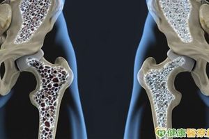 X光驚見骨頭坑坑洞洞　攝護腺癌骨轉移這樣治療可保骨