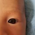 別大意！3歲女童眼中有白點！就醫發現竟是眼癌!