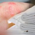 手背有很多疙瘩還起水泡？小心「千萬蟎蟲」陪你一起睡！教你3招讓「床墊像新的一樣乾凈」，還徹底除菌殺蟎！