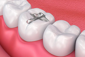 以後可能不需要補牙了！研究：牙能借力再生