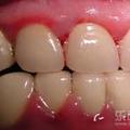 刷牙老是出血？「牙齦出血」要當心，多種慢性病前兆從牙齒看出來！