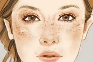 別大意！雀斑正悄悄地出現在你臉上！預防紫外線的12種方法，幫助你皮膚白皙，透亮無暇！