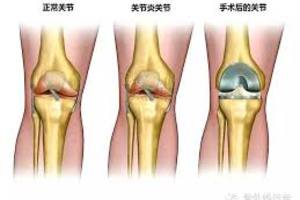 3種膝關節置換手術比一比