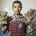 真實「格魯特」？孟加拉男子患罕見疾病　手腳如樹枝