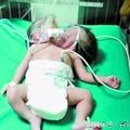 印度农妇诞下双头女婴 共用一副躯干