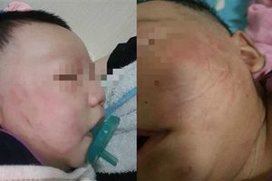 3月嬰遭父狠打　雙頰都是紅腫巴掌印
