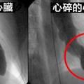 科學家證實[失去摯愛心碎是真的]可能嚴重到甚至還會讓「心臟停止跳動」