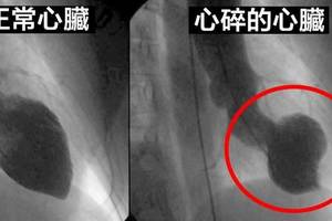 科學家證實[失去摯愛心碎是真的]可能嚴重到甚至還會讓「心臟停止跳動」