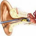 教你如何正確輕鬆清除堵塞耳朵裡的耳垢！必收藏！ 