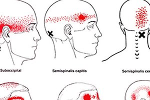 5種「經常被輕忽但不立即就醫其實能致命」的頭痛癥兆。睡覺醒來頭痛原來這麼嚴重！
