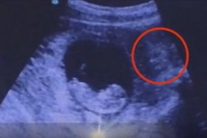 诡异！这张胎儿B超显示子宫外惊现〝恶魔〞！