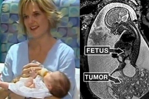 女嬰在媽媽肚子裡與巨大腫瘤一起成長共處，為了救她一命醫生竟然做出這種事...簡直駭人聽聞！