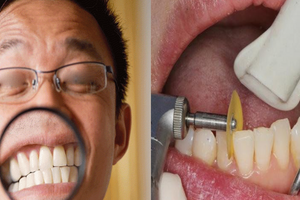 「磨牙」完全不是你想的一回事！它是「這種病」的發病徵兆！再不治難纏終身！