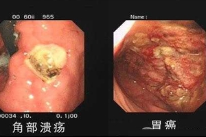 胃癌率最少的地方居然是在山東！！專家說：因為他們都吃這兩樣東西，抗癌真的很厲害！！