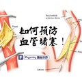 保護血管就等於保護你的生命，怎樣預防血管堵塞呢？