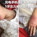 手機爆炸致5歲女孩八級傷殘，手機電池爆出來燃燒，滿臉漆黑，手也燒傷了索賠175萬元