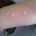 被蚊子咬後皮膚越抓越癢，教你三個止癢絕招，一分鐘止癢不留印痕
