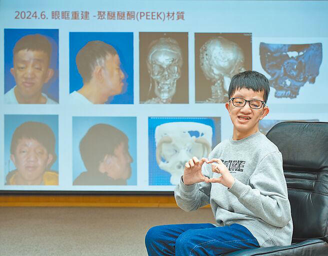 祐嘉(見圖)因先天性顱縫早閉,歷經20次大小手術,終於獲致近乎常人的功能及外觀,28日出席台大醫院顱顏醫療暨形態科學發展中心兩周年成果發表會,分享治療歷程。(羅永銘攝) 祐嘉(見圖)因先天性顱縫早閉,歷經20次大小手術,終於獲致近乎常人的功能及外觀,28日出席台大醫院顱顏醫療暨形態科學發展中心兩周年成果發表會,分享治療歷程。(羅永銘攝)